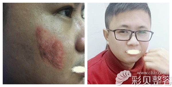 北京海医悦美刘文阁主任无创疤痕修复术后对比案例效果照展示