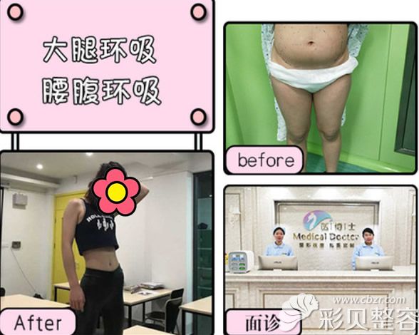 佛山医博士刘哲医生腰腹吸脂+大腿环形吸脂效果案例