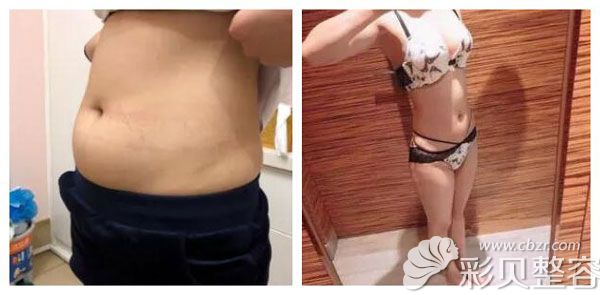 北京海医悦美整形刘文阁做腰腹部吸脂案例效果对比图