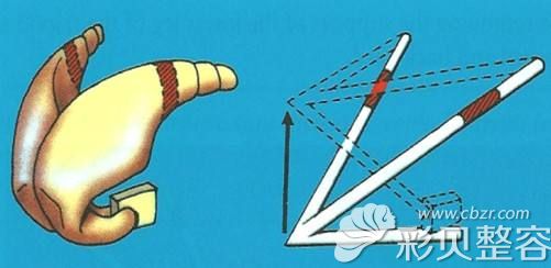 张哲给出隆鼻三脚架理论 张哲给出隆鼻三脚架理论