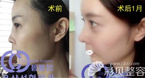韩国碧夏隆鼻术前与术后1月效果对比图