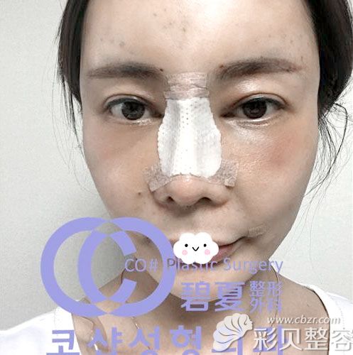 韩国碧夏鼻综合隆鼻+自体脂肪面部填充术后效果