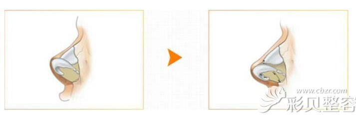 朝天鼻该怎么矫正 朝天鼻该怎么矫正