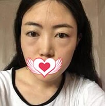我找北京紫洁王春燕做内切去眼袋手术后神秘的隐藏了年龄