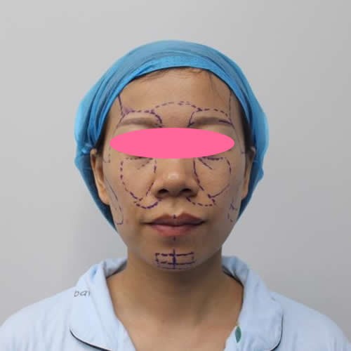 渭南德尔美客自体脂肪填充全脸+肋软骨隆鼻2个月效果图分享