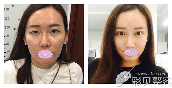 北京韩成陈保利医生双眼皮下垂修复，全切双眼皮+开眼角术后30恢复图对比