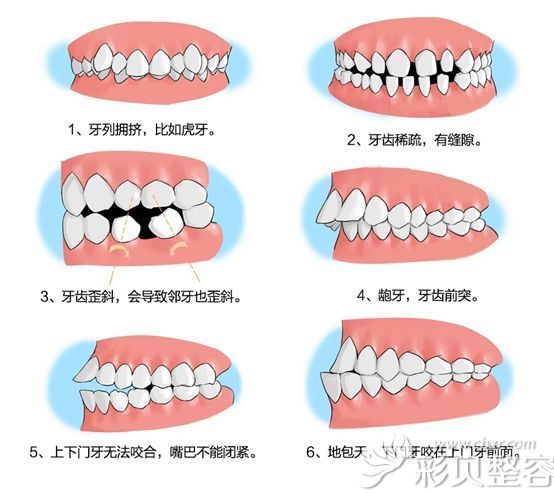 牙齿排列不齐的症状
