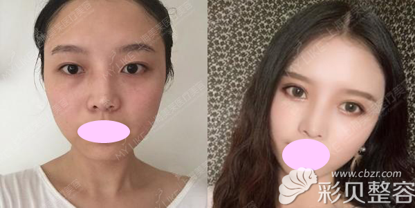 上海美莱整形双眼皮隆鼻脂肪填充案例集合 满足各类求美者