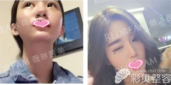 北京薇琳医美王小东膨体隆鼻案例展示