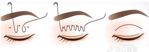 压线双眼皮手术方法展示图