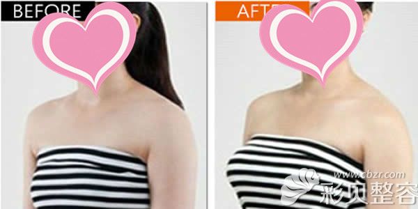 北京薇琳医美胡医生自体脂肪隆胸前后对比照展示