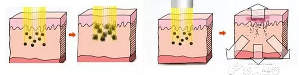 激光祛斑图片 激光祛斑图片