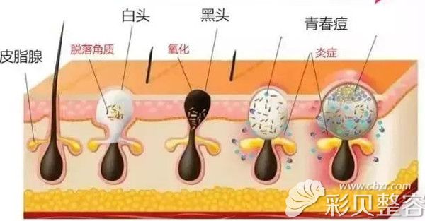 毛孔粗大很尴尬北京薇琳董香君超皮秒.果酸焕肤法教你摆脱