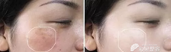 激光祛斑效果对比 激光祛斑效果对比