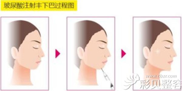 玻尿酸注射丰下巴过程图
