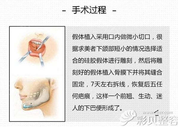 假体垫下巴手术方法展示图