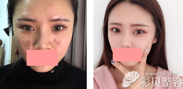 乌鲁木齐华美整形医院李天巧医生激光祛斑对比图 乌鲁木齐华美整形医院李天巧医生激光祛斑对比图