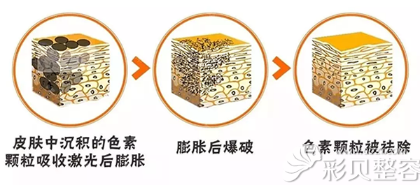 激光祛斑的原理 激光祛斑的原理