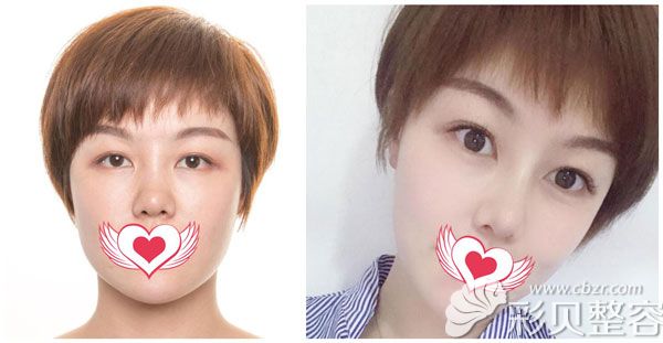 于大山做肋软骨隆鼻+耳软骨垫鼻尖案例效果对比图