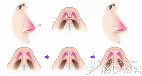 鼻尖整形手术过程