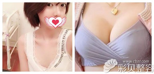 陈诚做硅胶假体隆胸案例效果对比图
