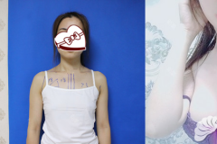 广州壹加壹自体脂肪或假体隆胸手术后是否会影响正常哺乳