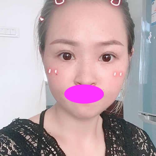 真没想到找十堰中爱铭医祁向峰割双眼皮才1个月恢复这么好