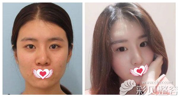 于大山做硅胶假体隆鼻+耳软骨垫鼻尖案例效果