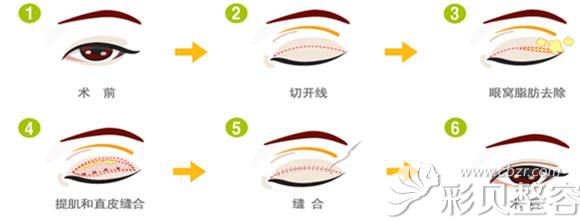 双眼皮切开法