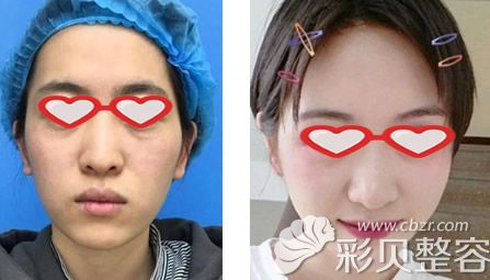 福州格莱美厚唇改薄两年后图片 福州格莱美厚唇改薄两年后图片