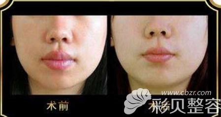 厚唇改薄七天恢复图 厚唇改薄七天恢复图