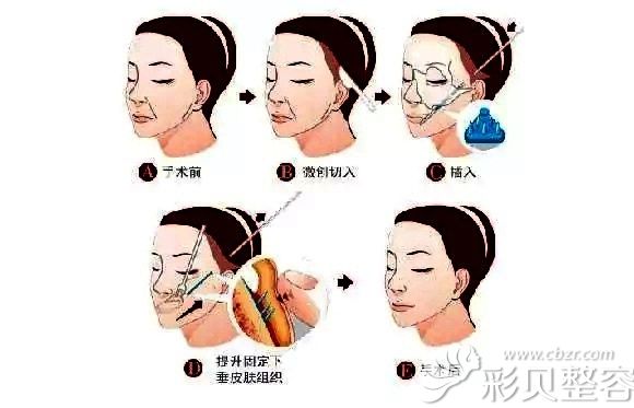 王院长做SMAS除皱术的手术原理图