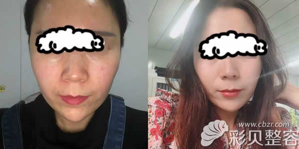 连云港华美整形真人激光祛斑案例效果对比图