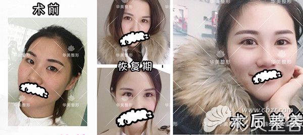 连云港华美孙振东院长双眼皮+开内眼角案例效果对比图