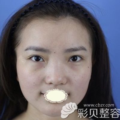 福州涣美医疗整形医院乐凤亮医生做膨体隆鼻术前照