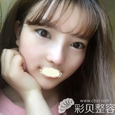 福州涣美乐凤亮医生膨体隆鼻术后15天恢复图