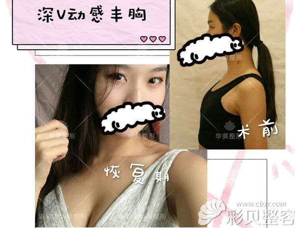 连云港华美整形刘记主任假体隆胸一年后效果对比图