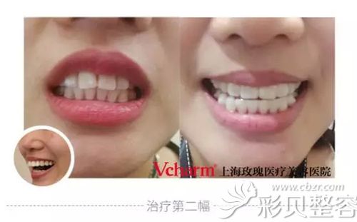 上海玫瑰隐形牙齿矫正案例