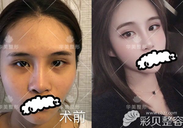 连云港华美整形自体脂肪填充全脸真人案例一个月效果图