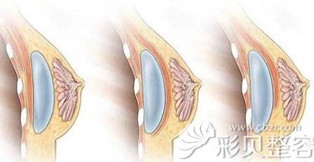 并且有时还会导致假体移位,进而扭曲乳房形状,所以说包膜挛缩是假体