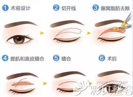 北京伊美康做切开双眼皮手术过程