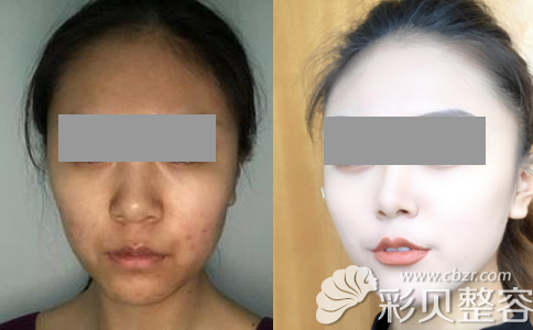 东莞维多利亚陈志勇硅胶隆鼻案例