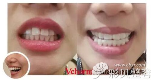 上海玫瑰牙齿矫正前后对比案例