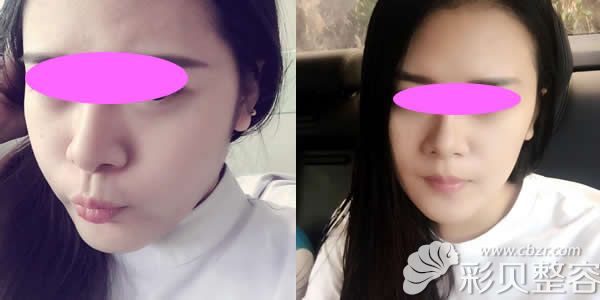 呼和浩特华美整形王冀耕自体脂肪全脸填充3个月效果图