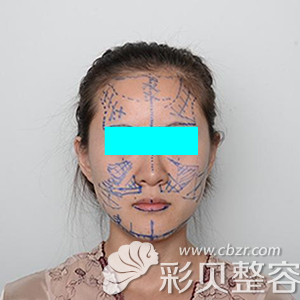 北京医美美容医院王东医生的脂肪填充术前设计