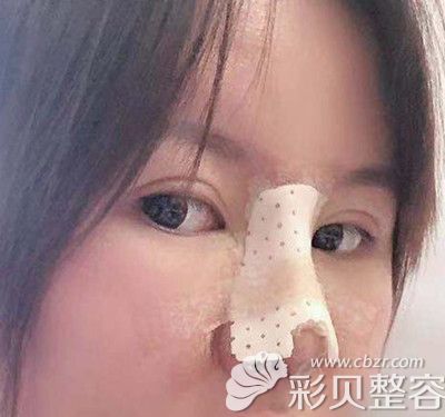 北京惠和嘉美胡俊峰硅胶假体隆鼻+耳软骨垫鼻尖术后2天效果