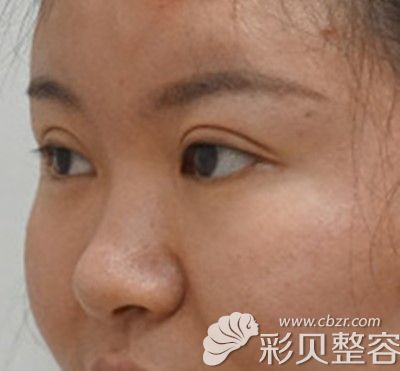 北京惠和嘉美医疗美容整形医院胡俊峰硅胶假体隆鼻+耳软骨垫鼻尖术前照