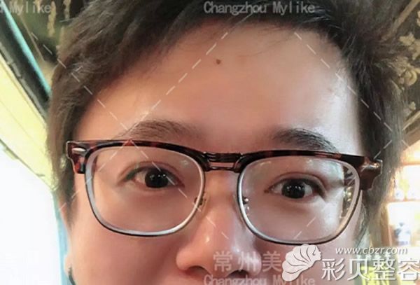 常州美莱赵春飞医生眼综合术后对比图展示