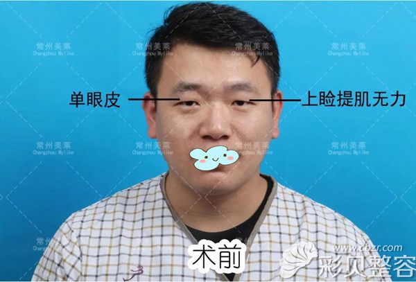 常州美莱男士做双眼皮术前对比照