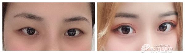 肿眼泡割了双眼皮的图片对比案例展示